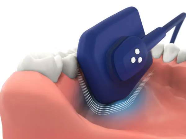 Радиовизиограф Vatech EzSensor Soft, цифровой (14, 8 микрон)