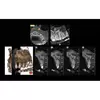 АйТиСтом | Hyperion X9 Pro 11x13 Ceph Titanium - дентальный цифровой 3D-томограф с цефалостатом, 3 в 1, FOV 11x13, изображение 3