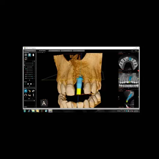АйТиСтом | CS 8100 3D - дентальный трехмерный томограф, FOV 8х9 см, изображение 7
