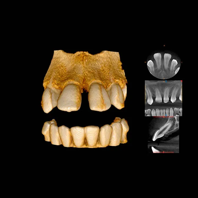 CS 8100 3D - дентальный трехмерный томограф, FOV 8х9 см