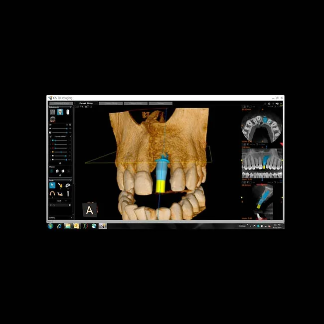 CS 8100 3D - дентальный трехмерный томограф, FOV 8х9 см