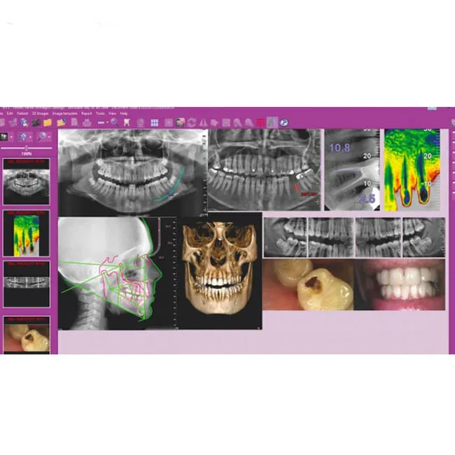 Hyperion X9 Pro 11x13 Ceph Titanium - дентальный цифровой 3D-томограф с цефалостатом, 3 в 1, FOV 11x13
