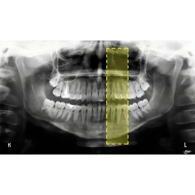 Hyperion X9 Pro 11x13 Ceph Titanium - дентальный цифровой 3D-томограф с цефалостатом, 3 в 1, FOV 11x13
