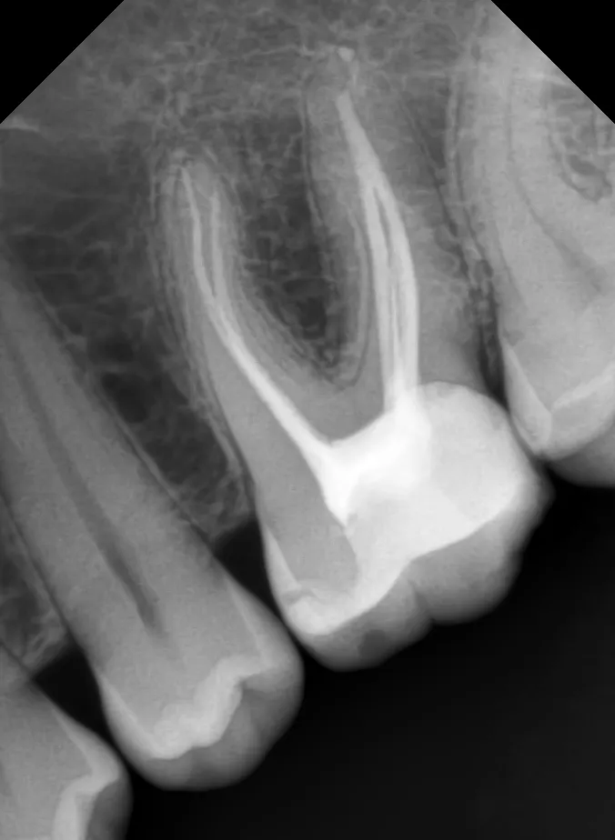 Радиовизиограф EzSensor (размер 1,5)